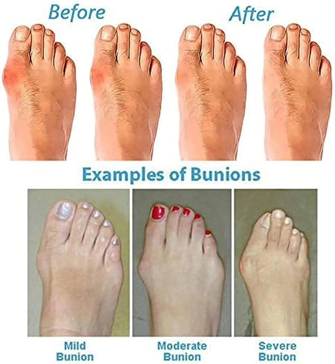 Comfy Flat Leather Sandals Bunion Corrector for Women Big Toe, Summer Non- Slip Sandals for Women Bunion Relief